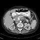 Chronic pancreatitis, calcified pancreatitis: CT - Computed tomography